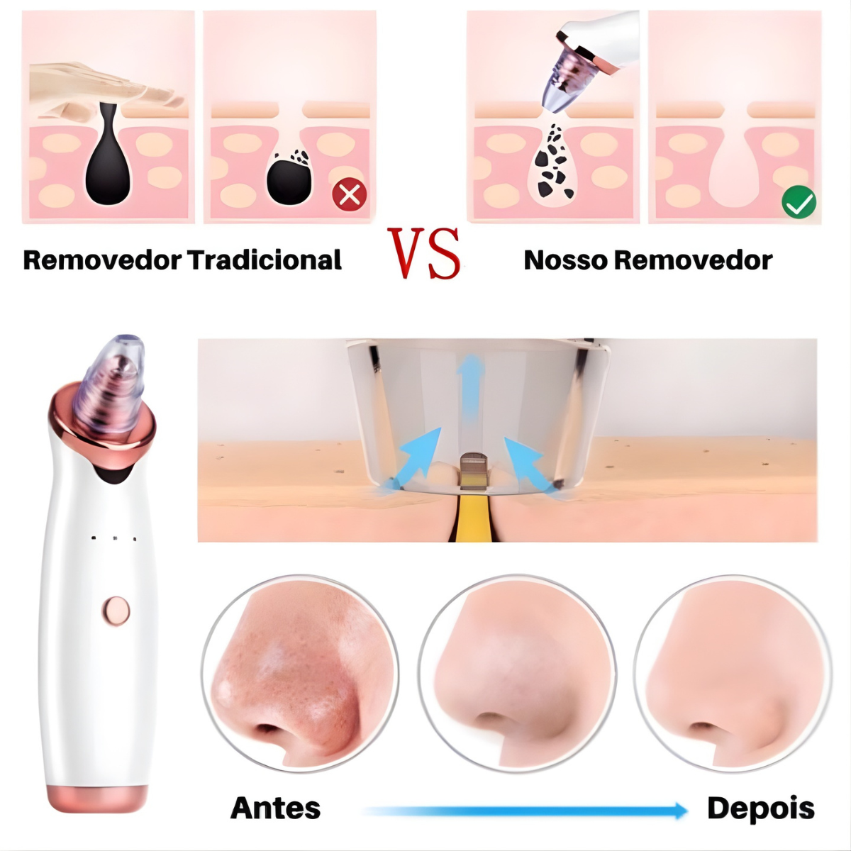 ✨ Removedor de Cravos e Espinhas a Vácuo | Recarregável USB com Ponteiras Profissionais